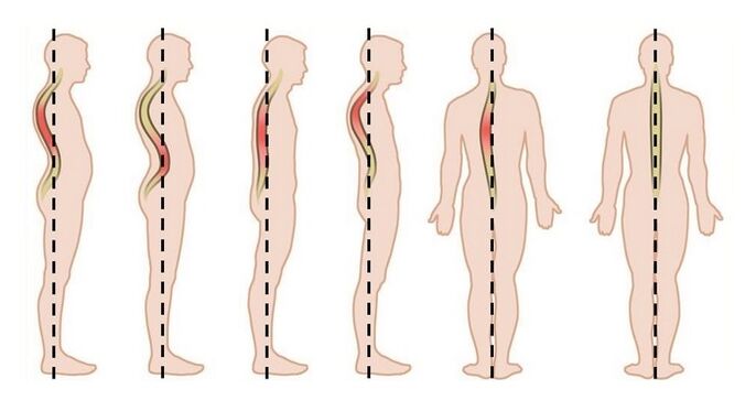 trastornos de la postura como causa de osteocondrosis torácica