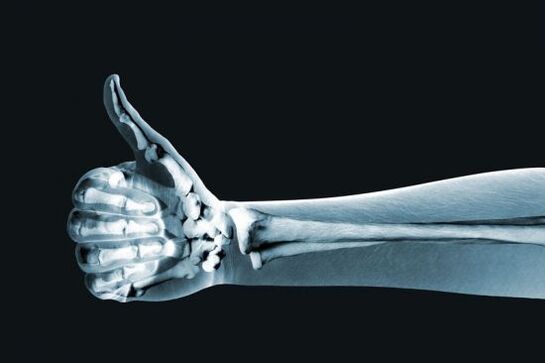 Los rayos X pueden ayudar a diagnosticar el dolor en las articulaciones de los dedos. 