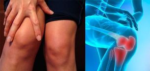 El malestar y la hinchazón en el área de la rodilla son los primeros síntomas de la artrosis. 