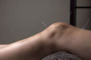 La acupuntura promueve la reparación del tejido articular
