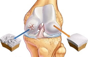 causas de la artrosis de la articulación de la rodilla
