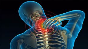 causas de la osteocondrosis del cuello
